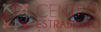 Una vez operada de su exotropia mejoró el rendimiento escolar y tuvo mayor aceptación en el grupo de compañeros de su clase y entorno.